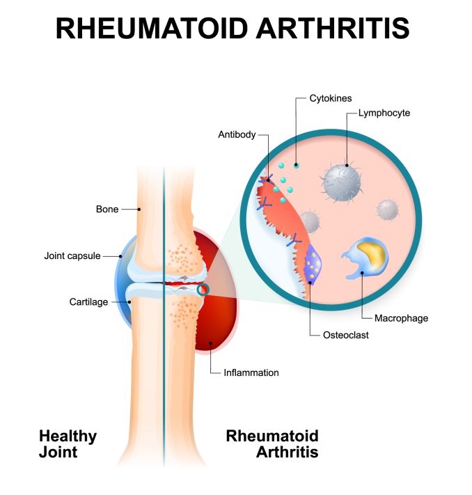 Arthritis – Causes, Symptoms and Treatment