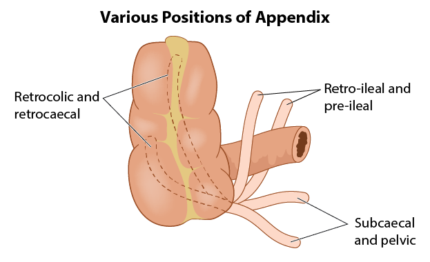 Appendicitis