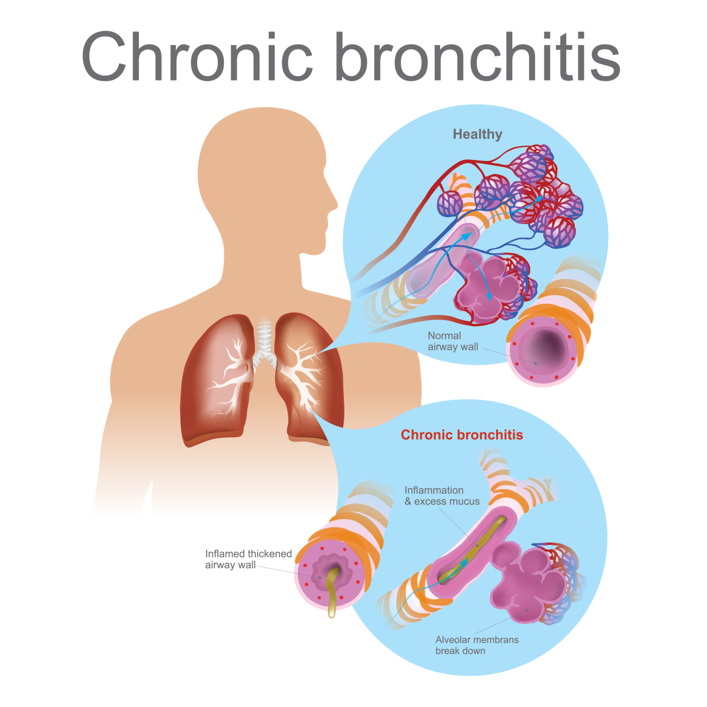 Bronchitis Symptoms, Causes, Diagnosis and Treatment