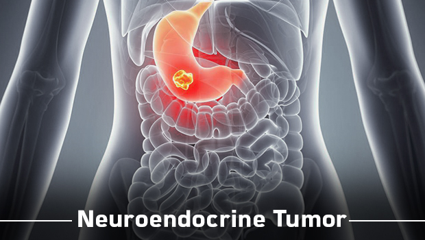 Neuroendocrine Tumour NET explained by Dr. Vijay Anand Reddy