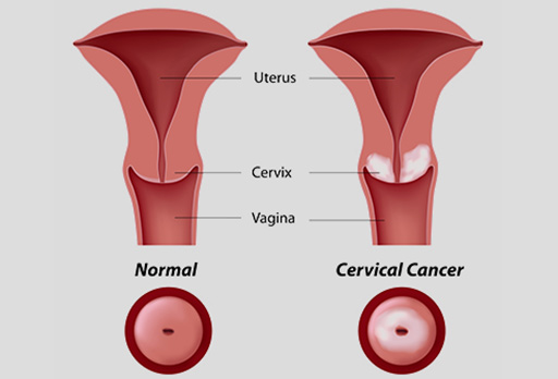 All You Need To Know About Cervical Cancer