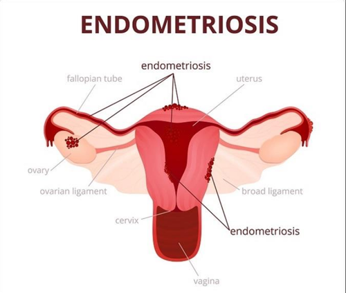 Endometriosis: Causes, Symptoms, Types, Treatment & Risk Factors