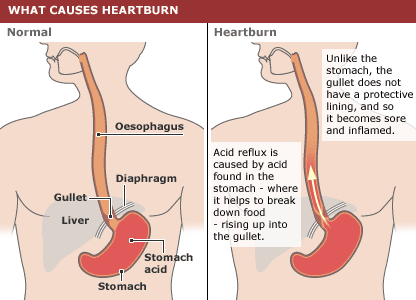 What is Heartburn or Gastroesophageal Reflux (GER)?