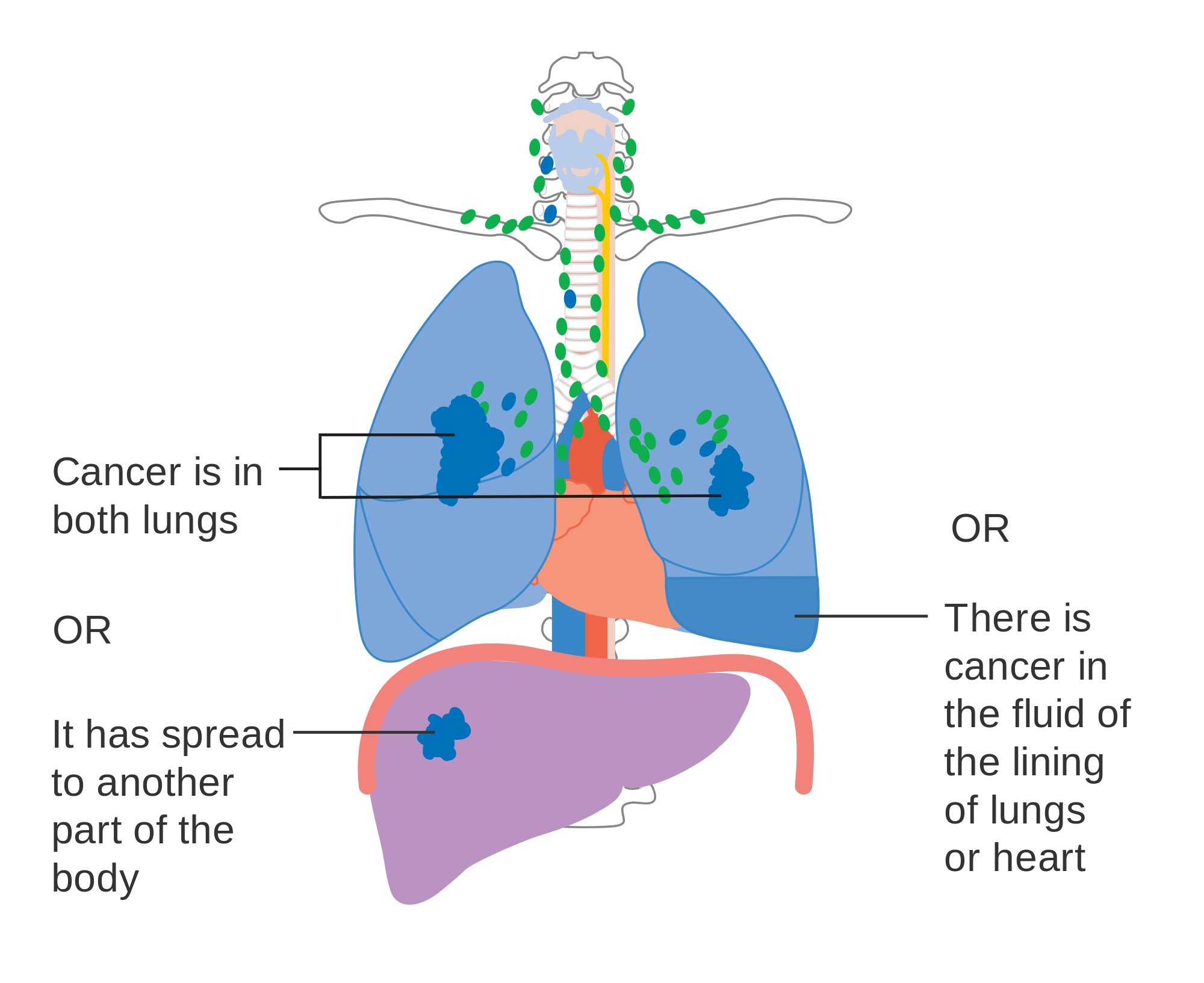 What are the 4 types of lung cancer?