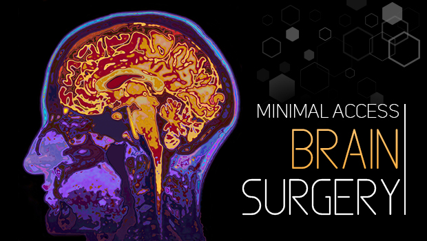 Minimal Access Brain Surgery