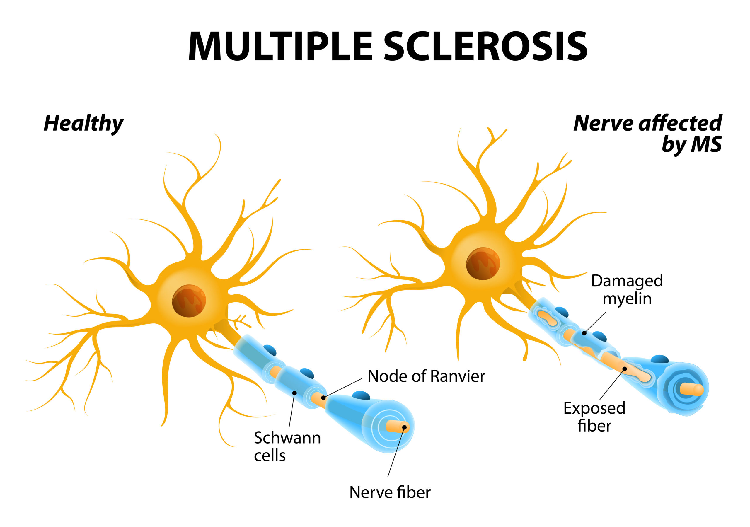 Multiple Sclerosis – Causes, Symptoms and Treatment