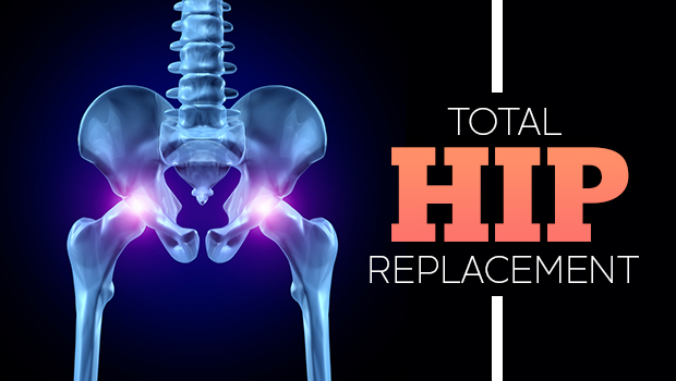 Total Hip Replacement