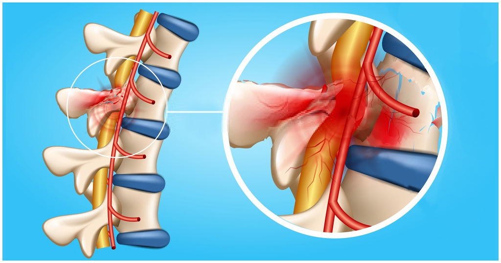 Spinal Cord Injury