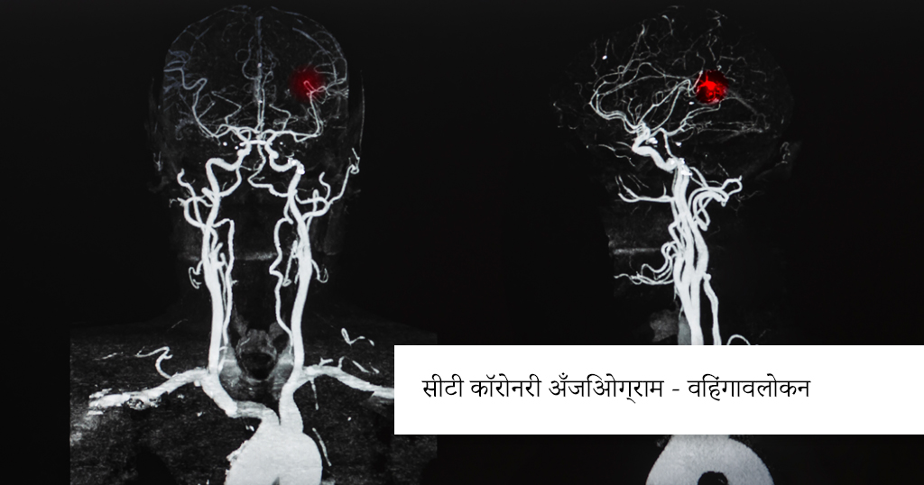 CT Coronary Angiogram