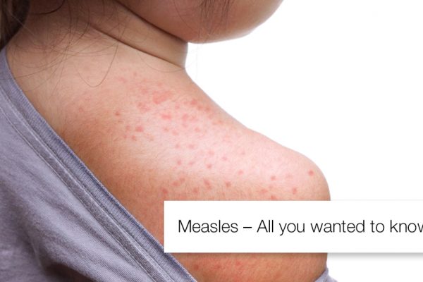 Measles – All you wanted to know