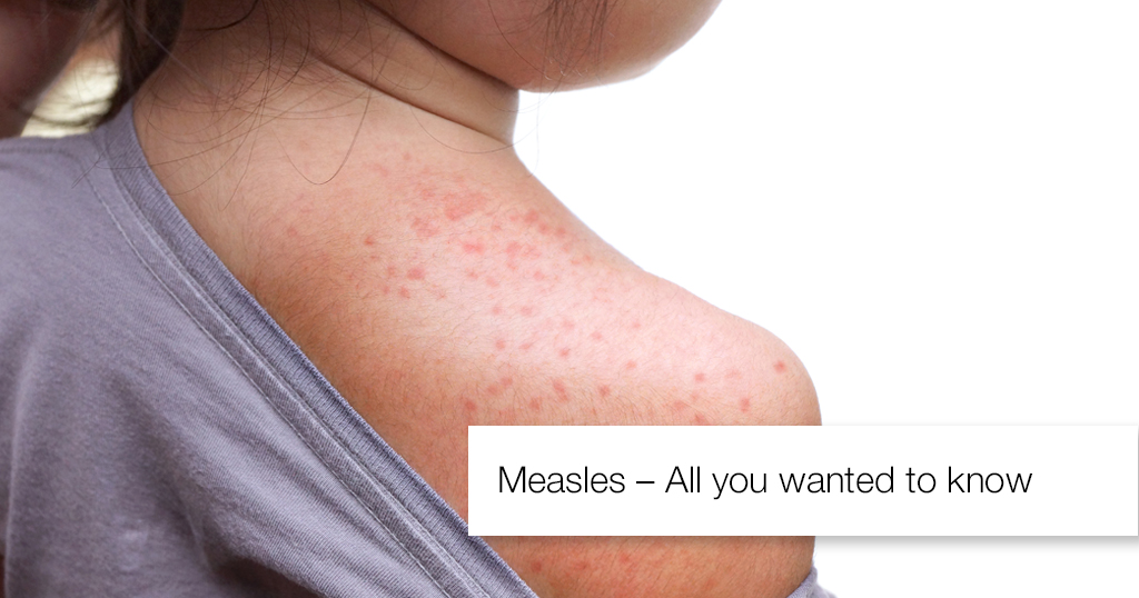 Measles – All you wanted to know