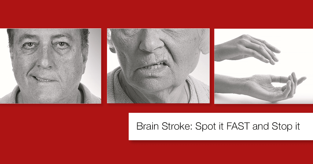 Brain Stroke: Spot it FAST and Stop it