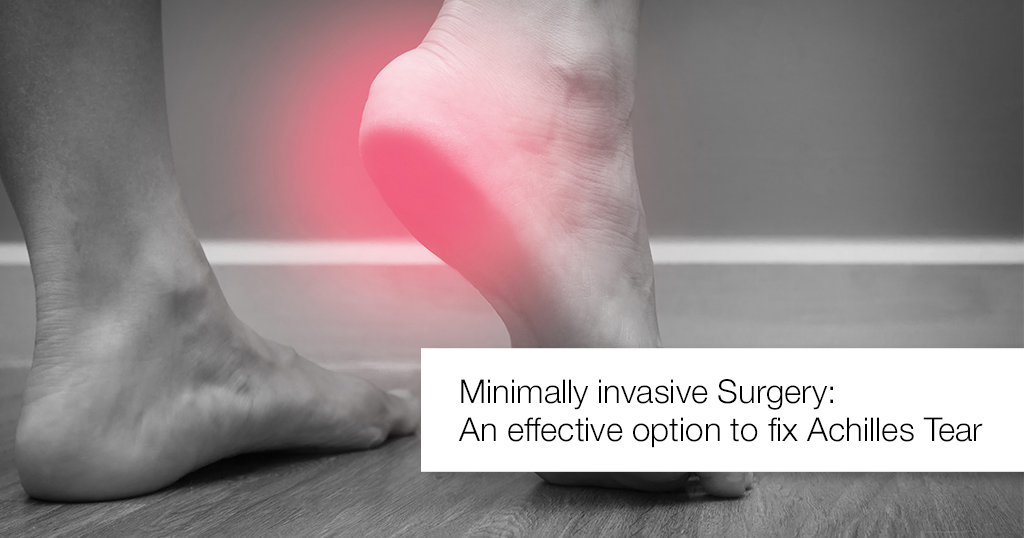 Minimally Invasive Surgery An Effective Option To Fix Achilles Tear