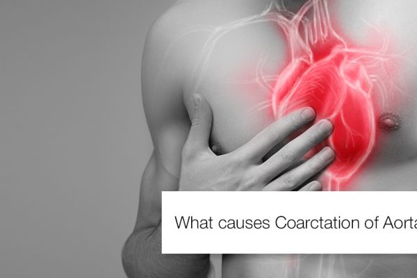 WHAT CAUSES COARCTATION OF AORTA?