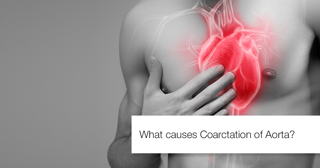 WHAT CAUSES COARCTATION OF AORTA?