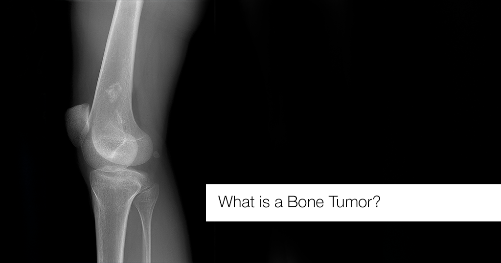 What Is A Bone Tumor?