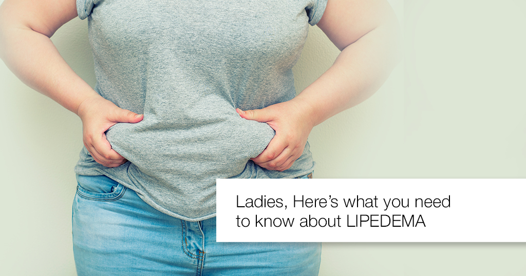 Lipedema – Symptoms, Causes and Treatment