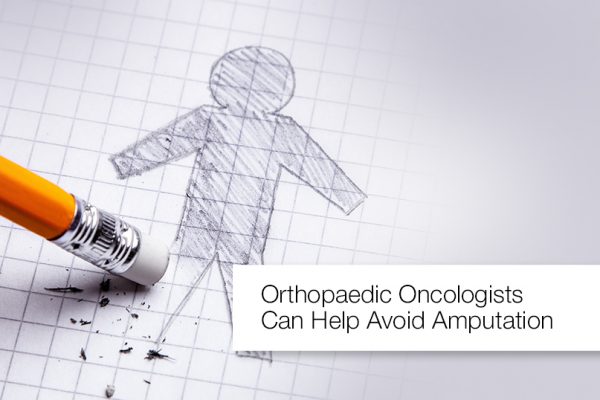 Orthopaedic Oncologists Can Help Avoid Amputation