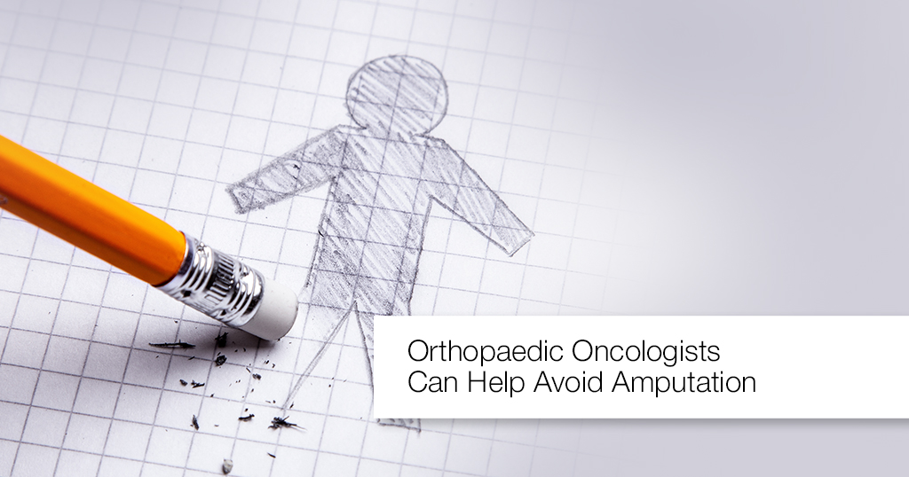 Orthopaedic Oncologists Can Help Avoid Amputation