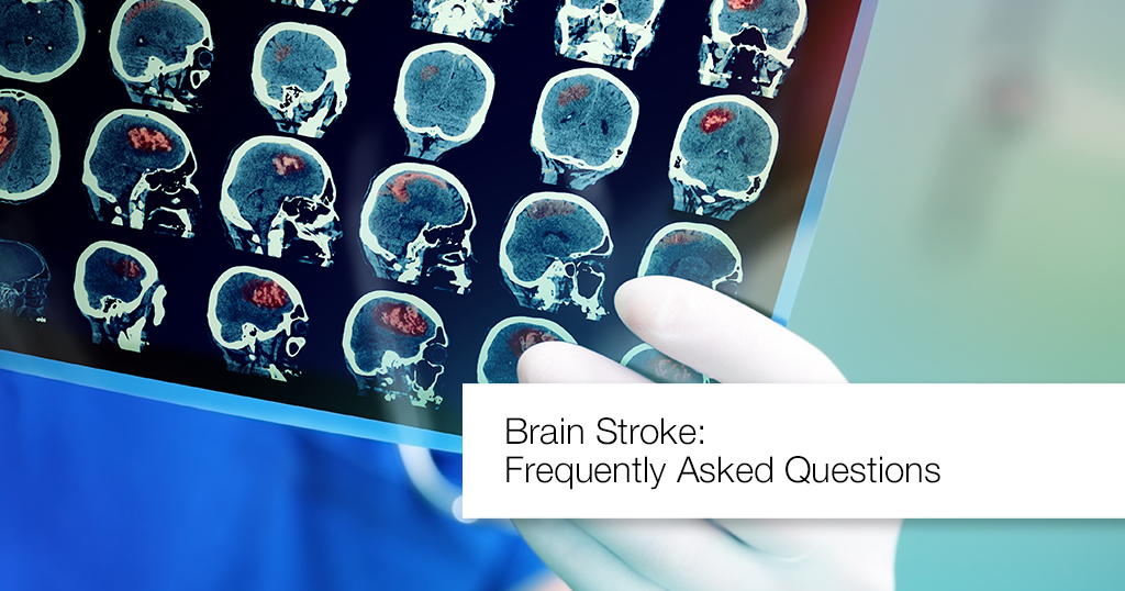 Brain Stroke – Symptoms, Risk Factors and Treatment