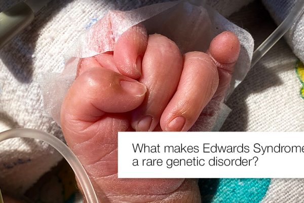 What makes Edwards Syndrome a rare genetic disorder