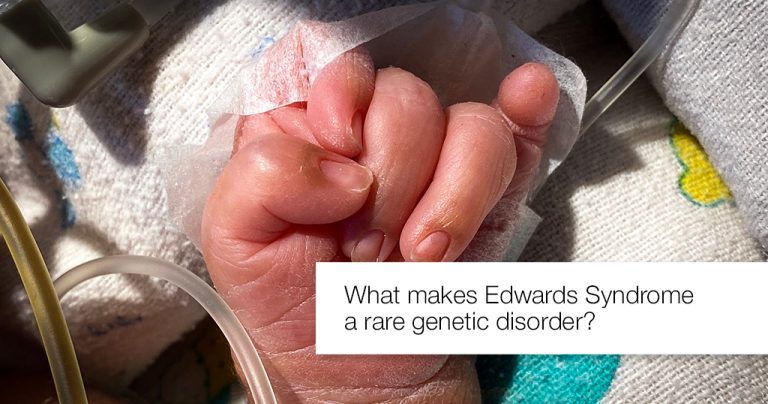 What makes Edwards Syndrome a rare genetic disorder - Apollo Hospitals Blog