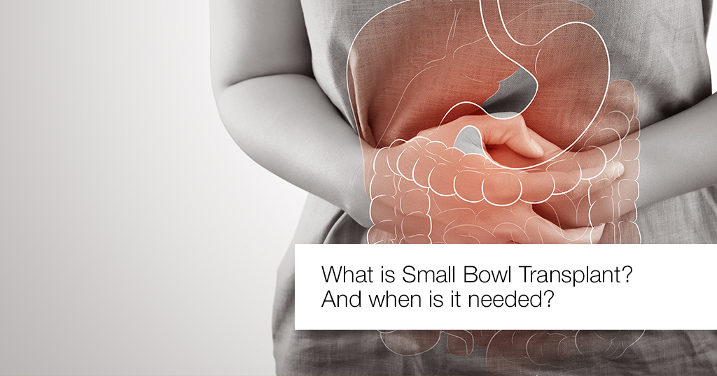 What is Small bowel transplant? When a small bowel transplant is needed?