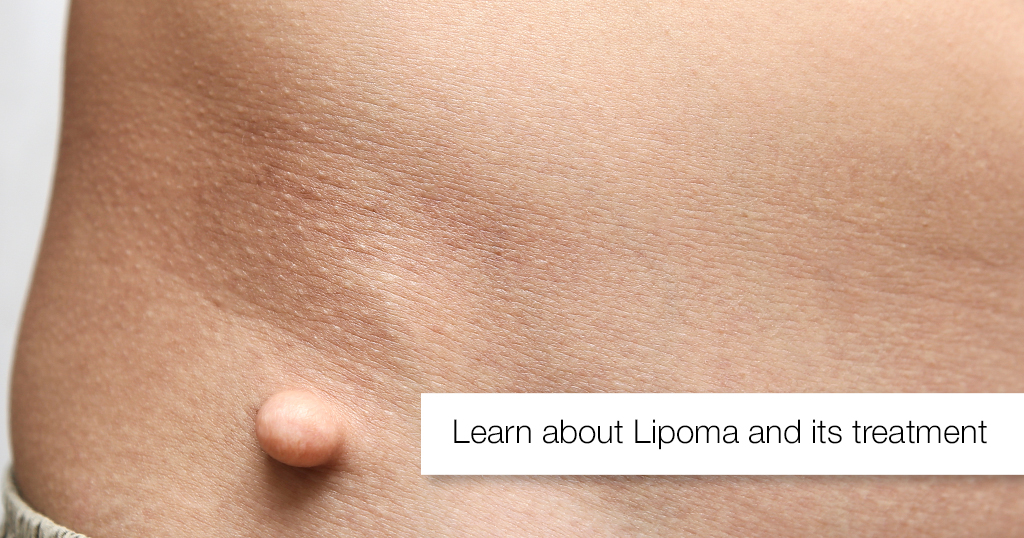 Learn about Lipoma and its treatment