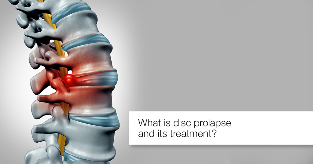 What is disc prolapse and its treatment?