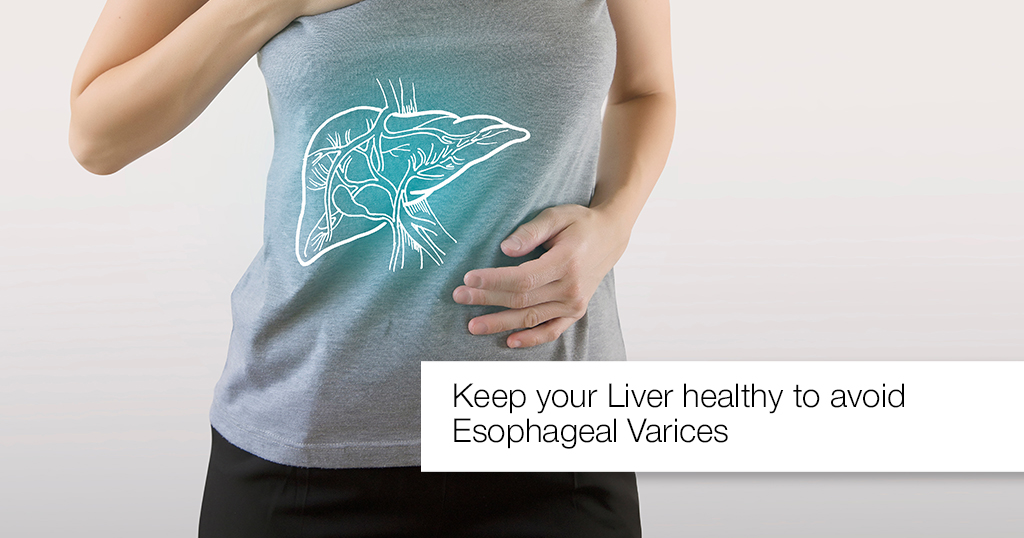 Keep your Liver healthy to avoid Esophageal Varices