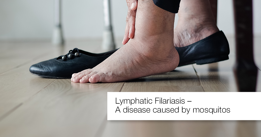 Lymphatic Filariasis – A Disease Caused by Mosquitos