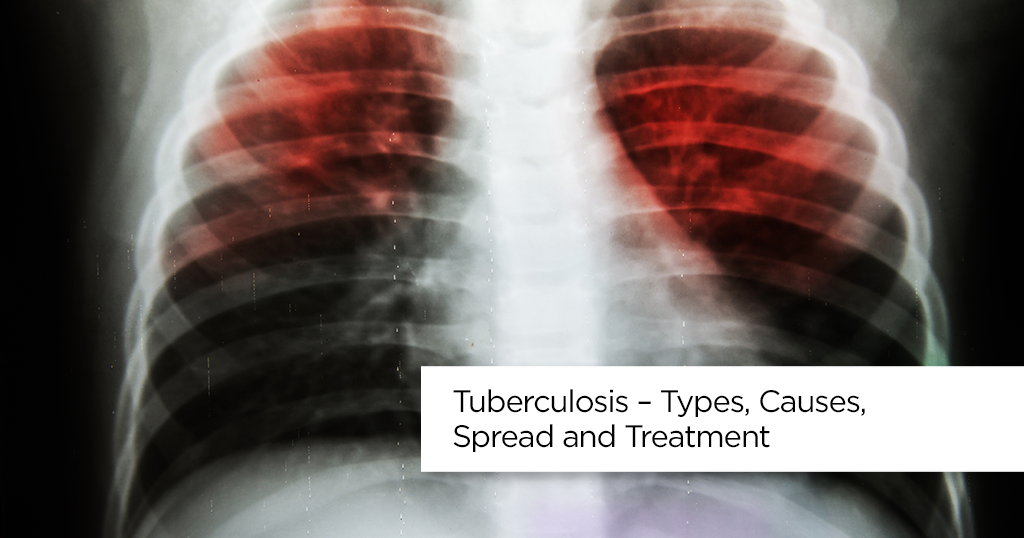 Tuberculosis – Types, Causes, Spread and Treatment