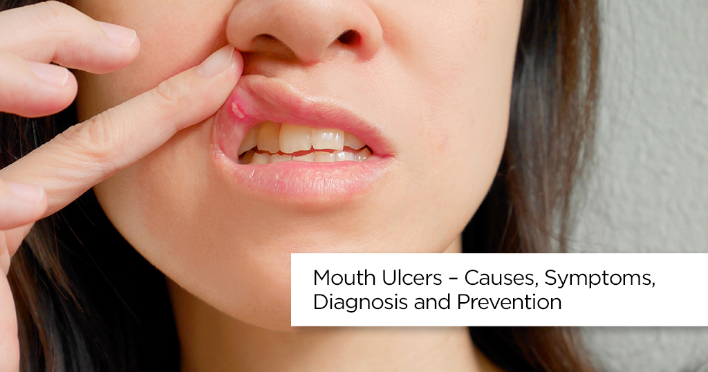 Mouth Ulcers – Causes, Symptoms, Diagnosis and Prevention