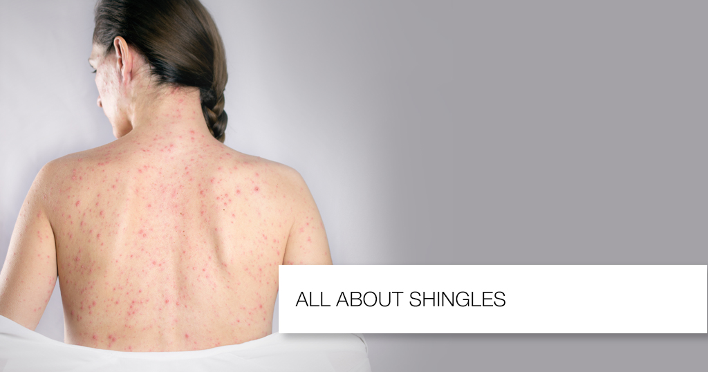 All About Shingles