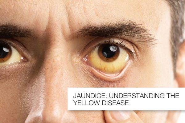 Jaundice: Understanding the Causes and Prevention of The Yellow Disease