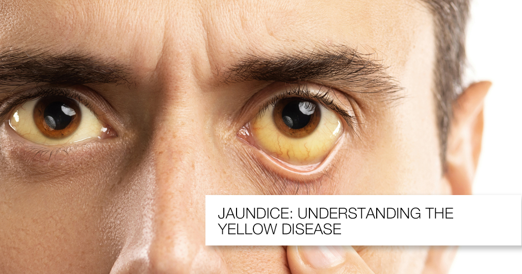 Jaundice: Understanding the Causes and Prevention of The Yellow Disease