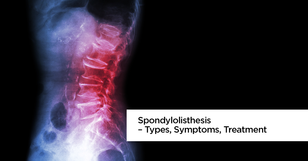 Spondylolisthesis – Types, Symptoms, Treatment