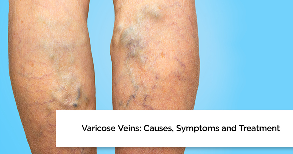 Varicose Veins: Causes, Symptoms and Treatment