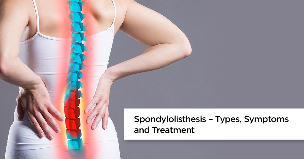 Spondylolisthesis – Types, Symptoms and Treatment