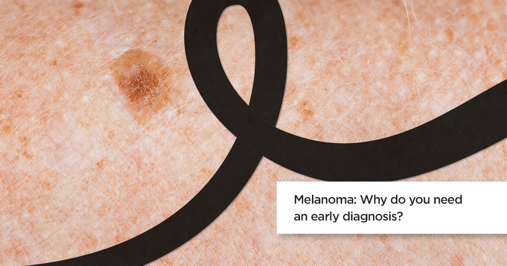 Melanoma: Why Do You Need An Early Diagnosis?