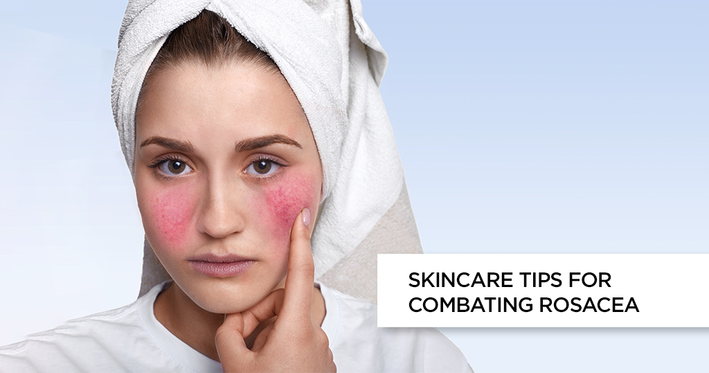 Skincare Tips for Combating Rosacea