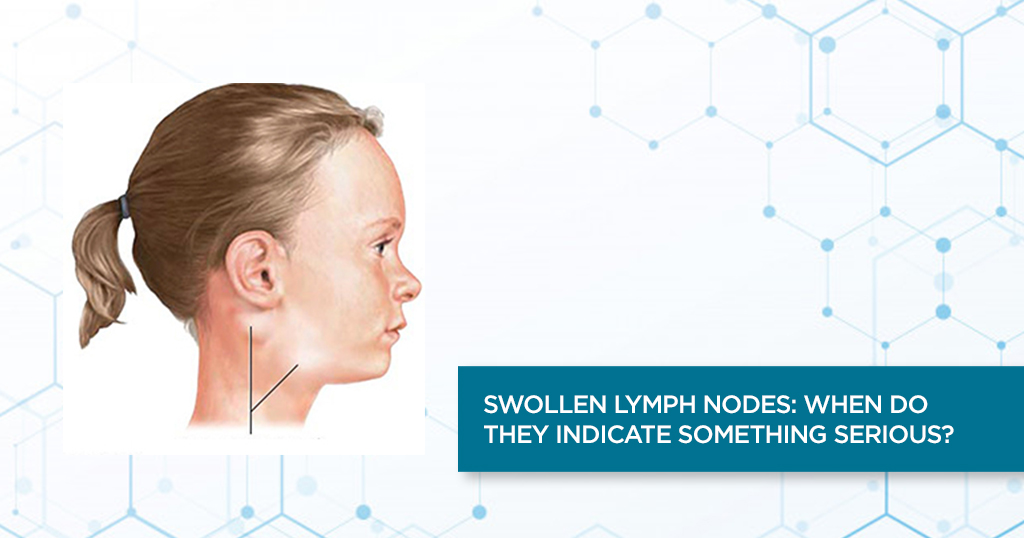 Swollen Lymph Nodes: When do they indicate something serious?