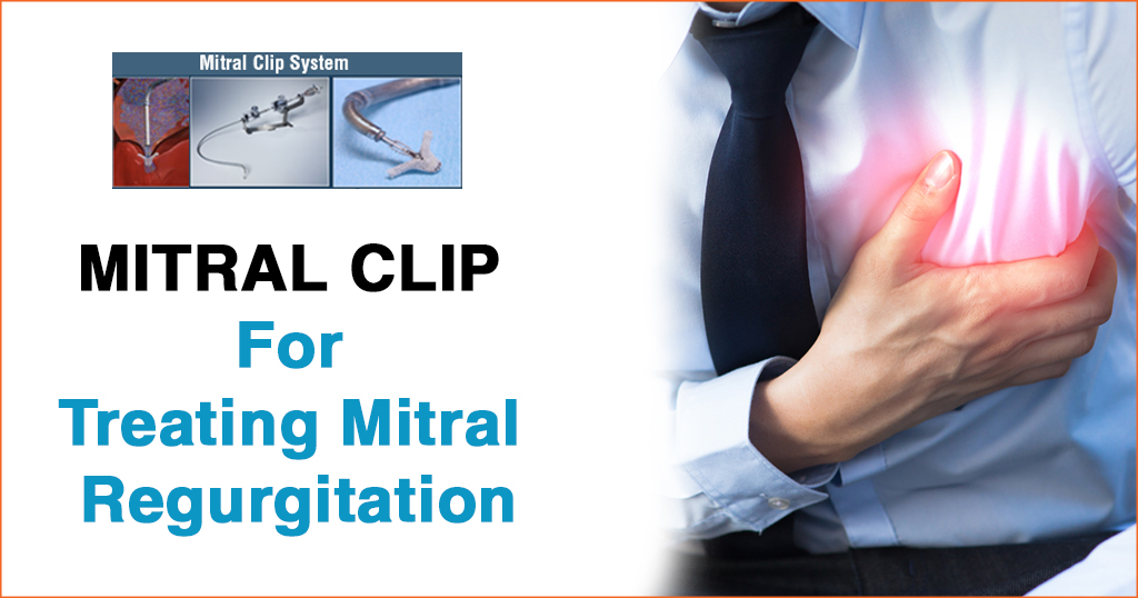 Mitral Clip – Breakthrough Innovation for Mitral Regurgitation