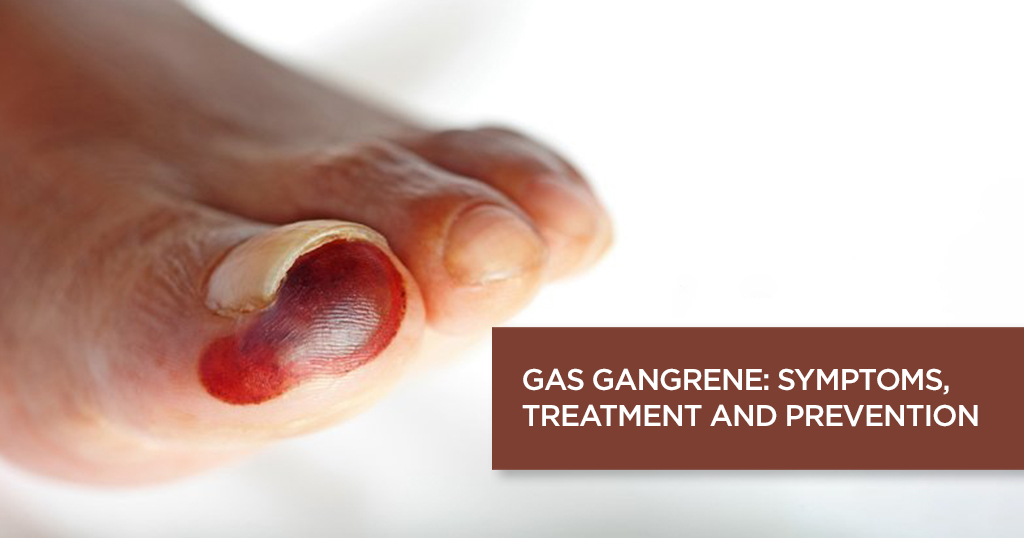 Gas Gangrene – Symptoms, Causes, Treatment and Prevention