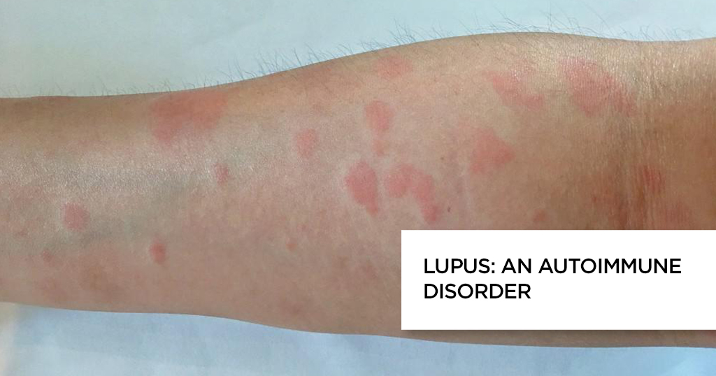 Lupus: An autoimmune disorder