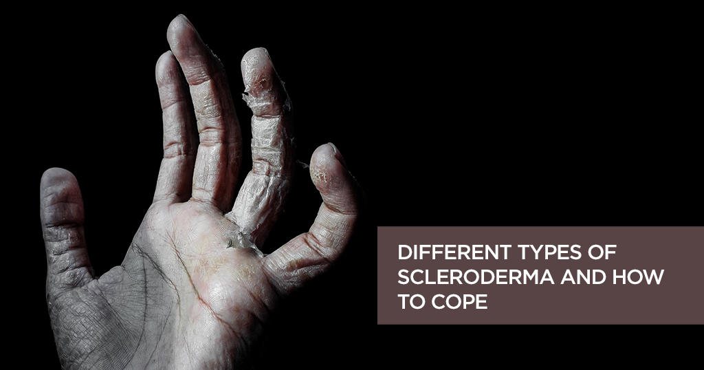 Different Types of Scleroderma and How to Cope