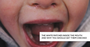 The White Patches Inside the Mouth And Why You Should Get Them Checked