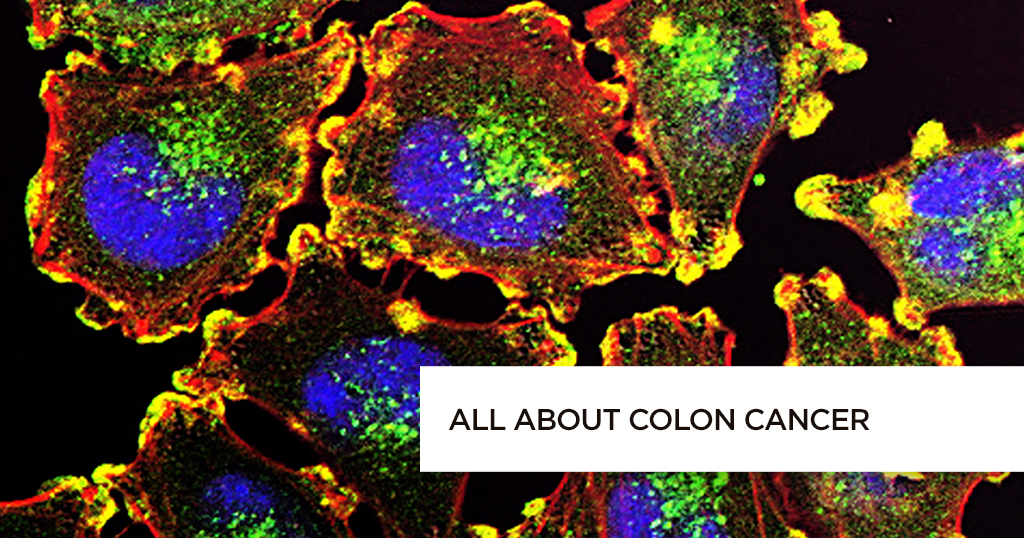 All about Colon Cancer