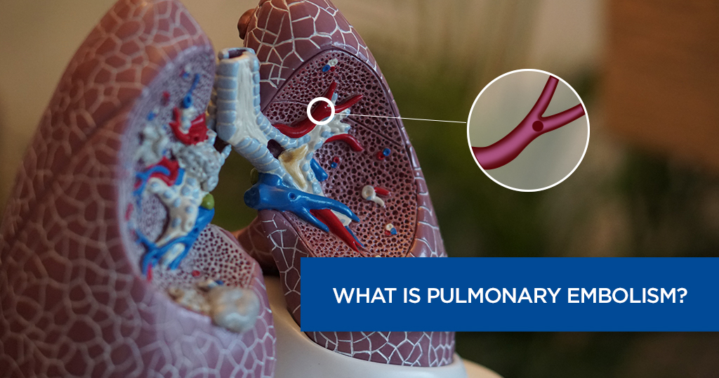 What Is Pulmonary Embolism?