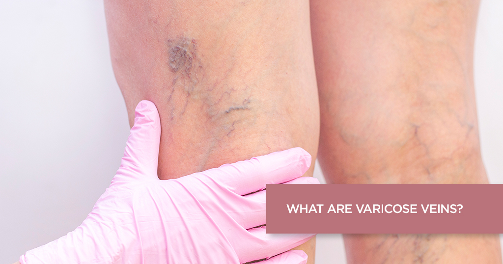 What are Varicose Veins?